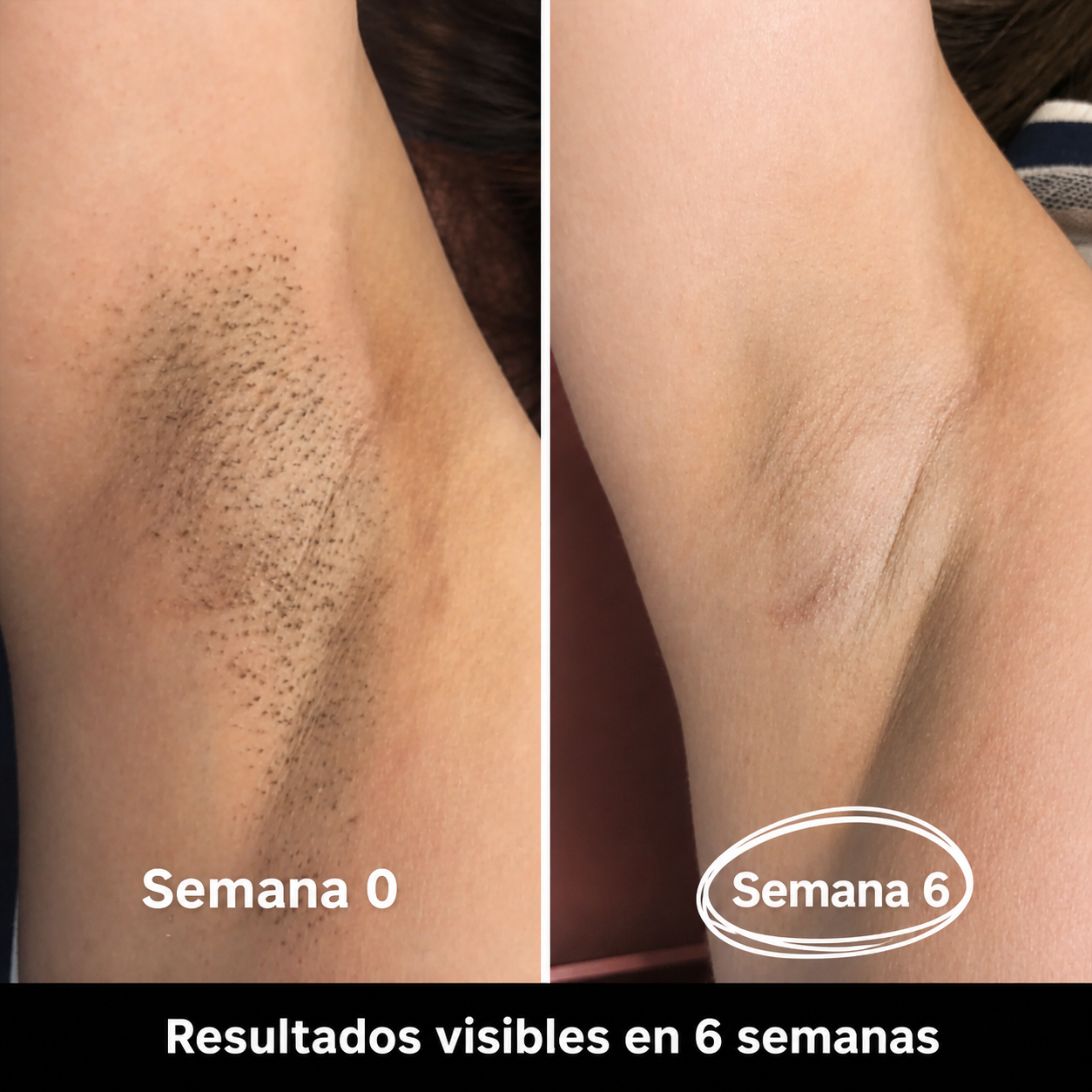 Depiladora IPL Permanente