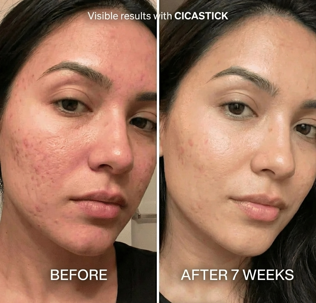 Clinical Acne Scar Remodelling Stick