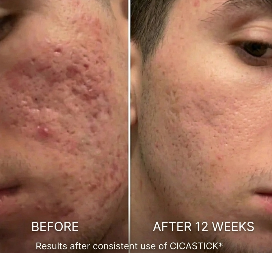 Clinical Acne Scar Remodelling Stick